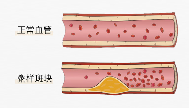 血栓是心梗、脑梗的元凶，很容易找上这些人