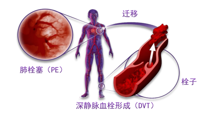 骨科术后重点关注的问题—VTE，该如何防治？