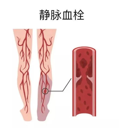 血栓是心梗、脑梗的元凶，很容易找上这些人