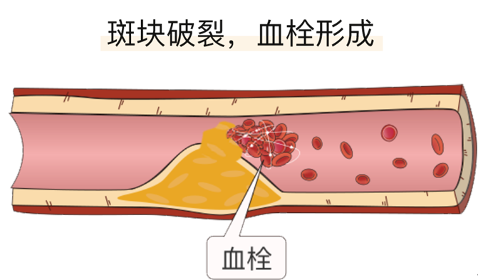 血栓是心梗、脑梗的元凶，很容易找上这些人