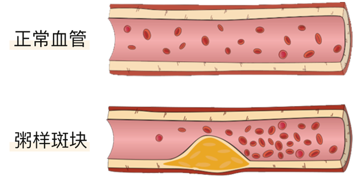 血栓是心梗、脑梗的元凶，很容易找上这些人