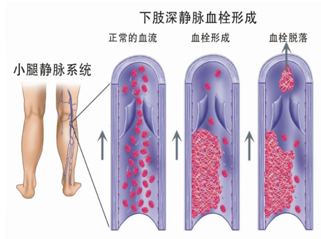 警惕！这个全球“第三大心血管杀手”，我们该如何应对？