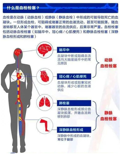 2022世界血栓日：就医有新路，血栓找介入