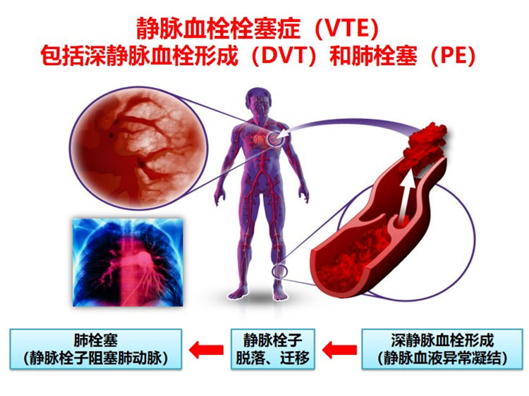 世界血栓日 | 拴不住，动起来