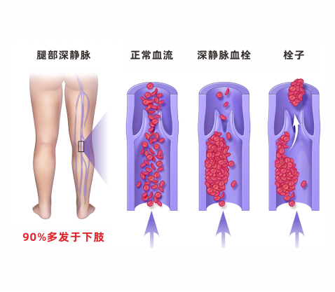 深静脉血栓类似病症的认识与区分