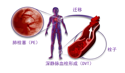 骨科术后重点关注的问题—VTE，该如何防治？