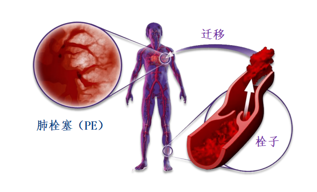 动脉血栓和静脉血栓有什么区别吗？