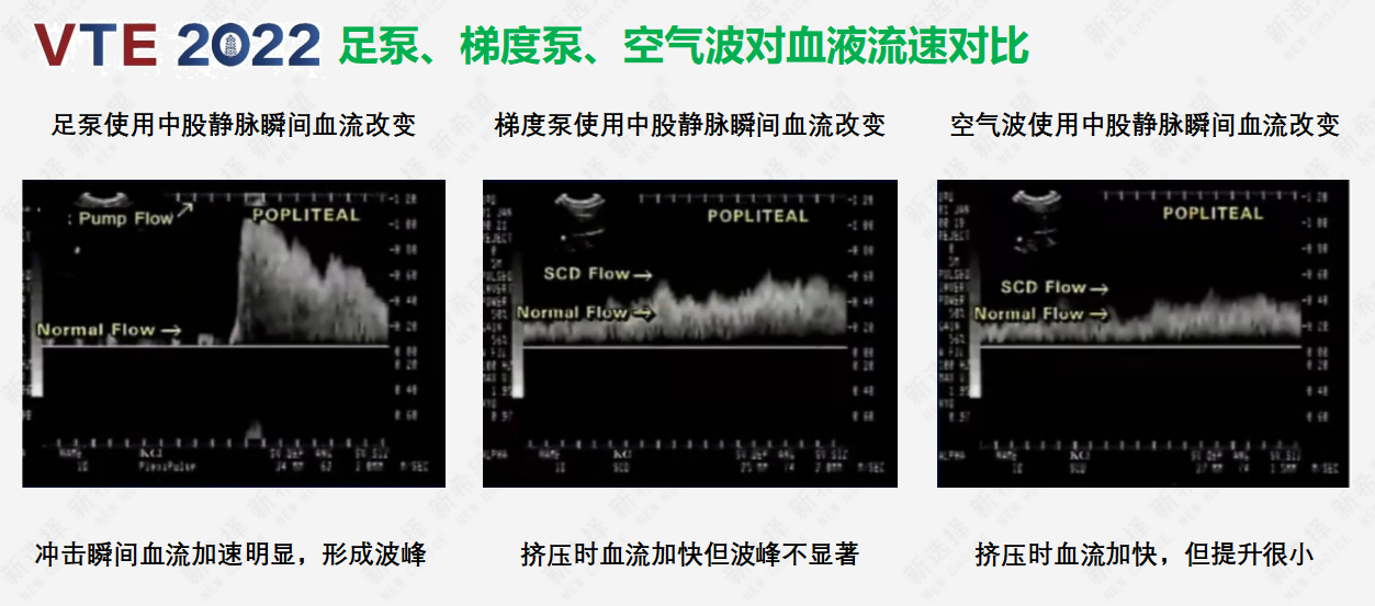 围术期患者VTE的预防，只知道抗凝可不行