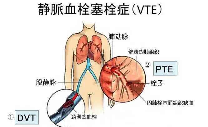 肾病综合症的VTE预防