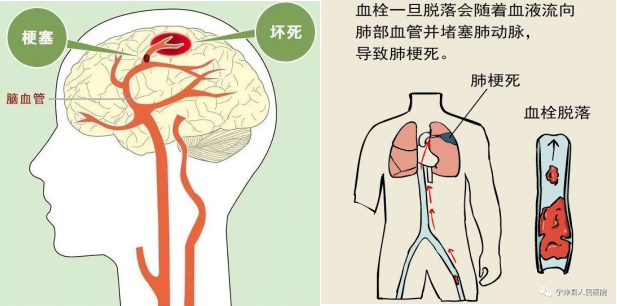 脑梗与深静脉血栓：不可忽视的血管危机