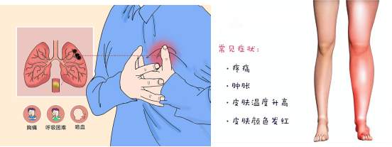 脑梗与深静脉血栓：不可忽视的血管危机